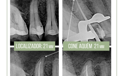 Forame anatômico x ápice radiográfico. A importância do localizador apical.