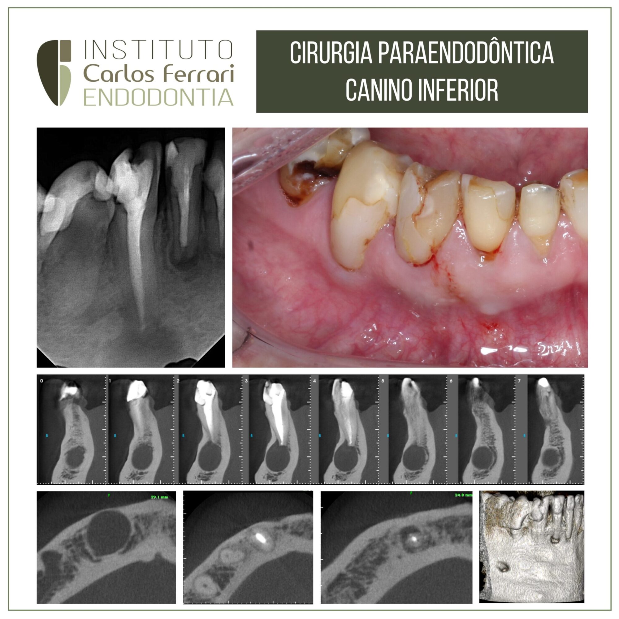 Apicectomia em canino inferior. Relato de caso.