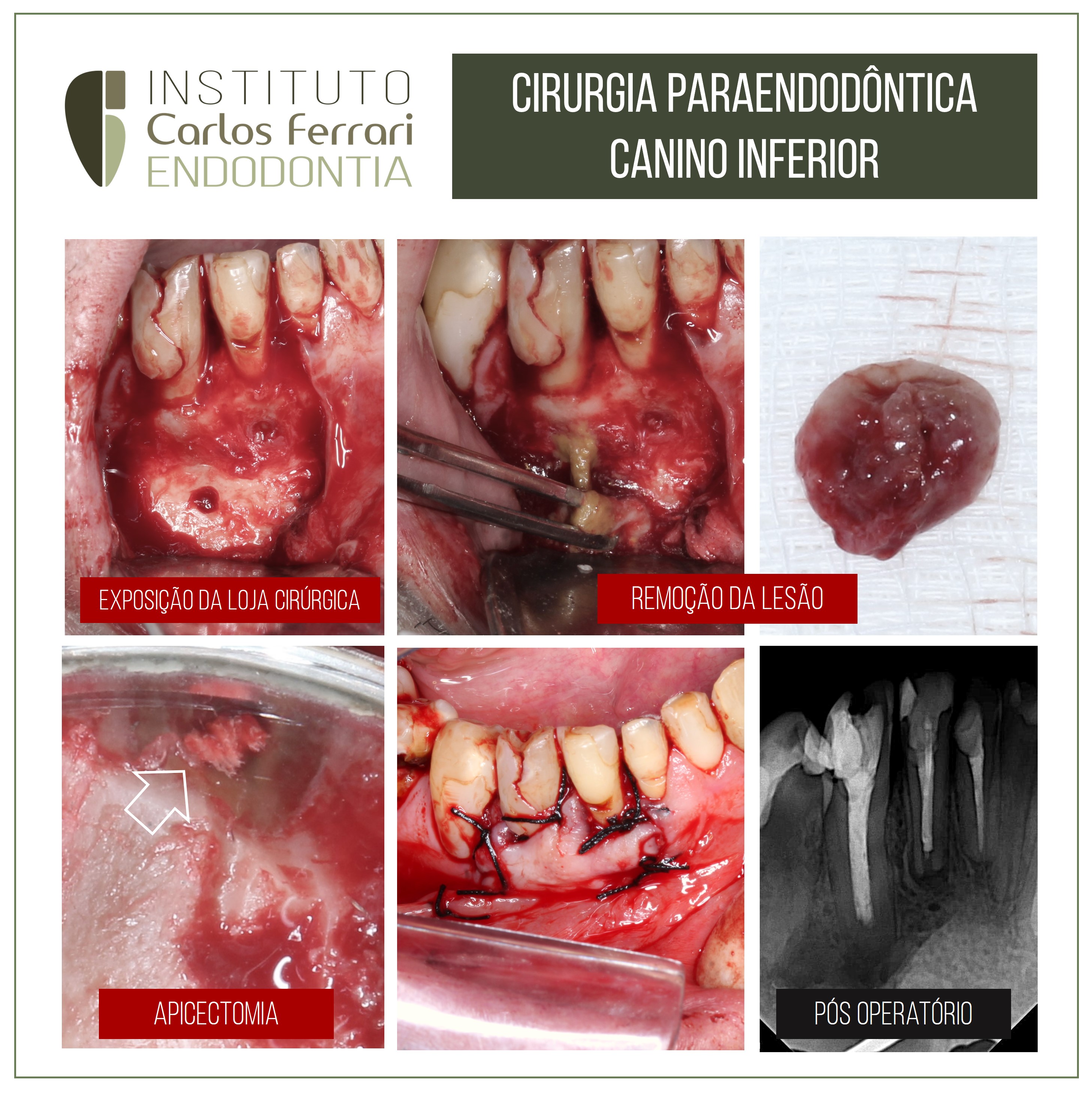 Apicectomia em canino inferior. Relato de caso.