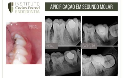 Rizogênese incompleta. Apicificação em 2 molar inferior.