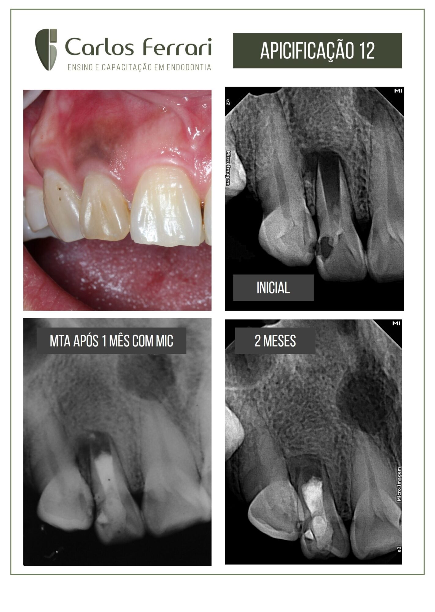 Apicificação em dente com rizogênese incompleta.