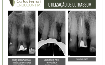 Canal calcificado. Resolução com auxílio de ultrassom.