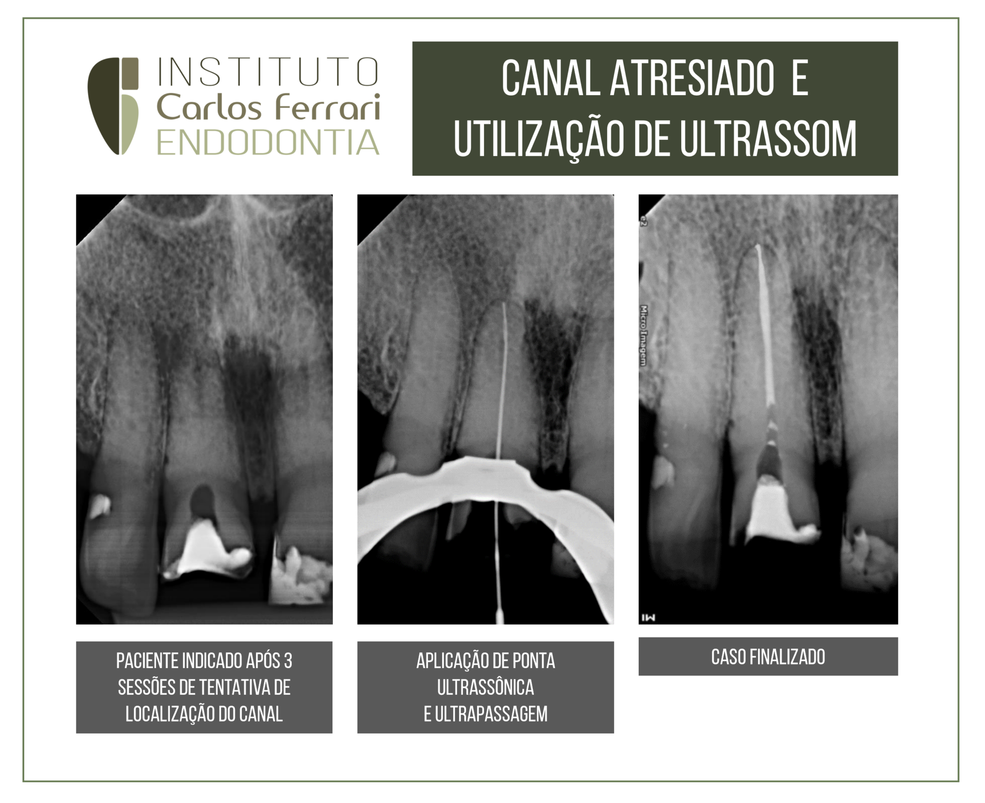 Canal calcificado. Resolução com auxílio de ultrassom.