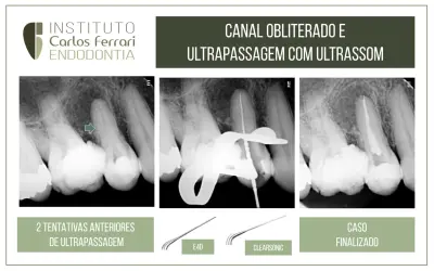 Canal obliterado e ultrassom.