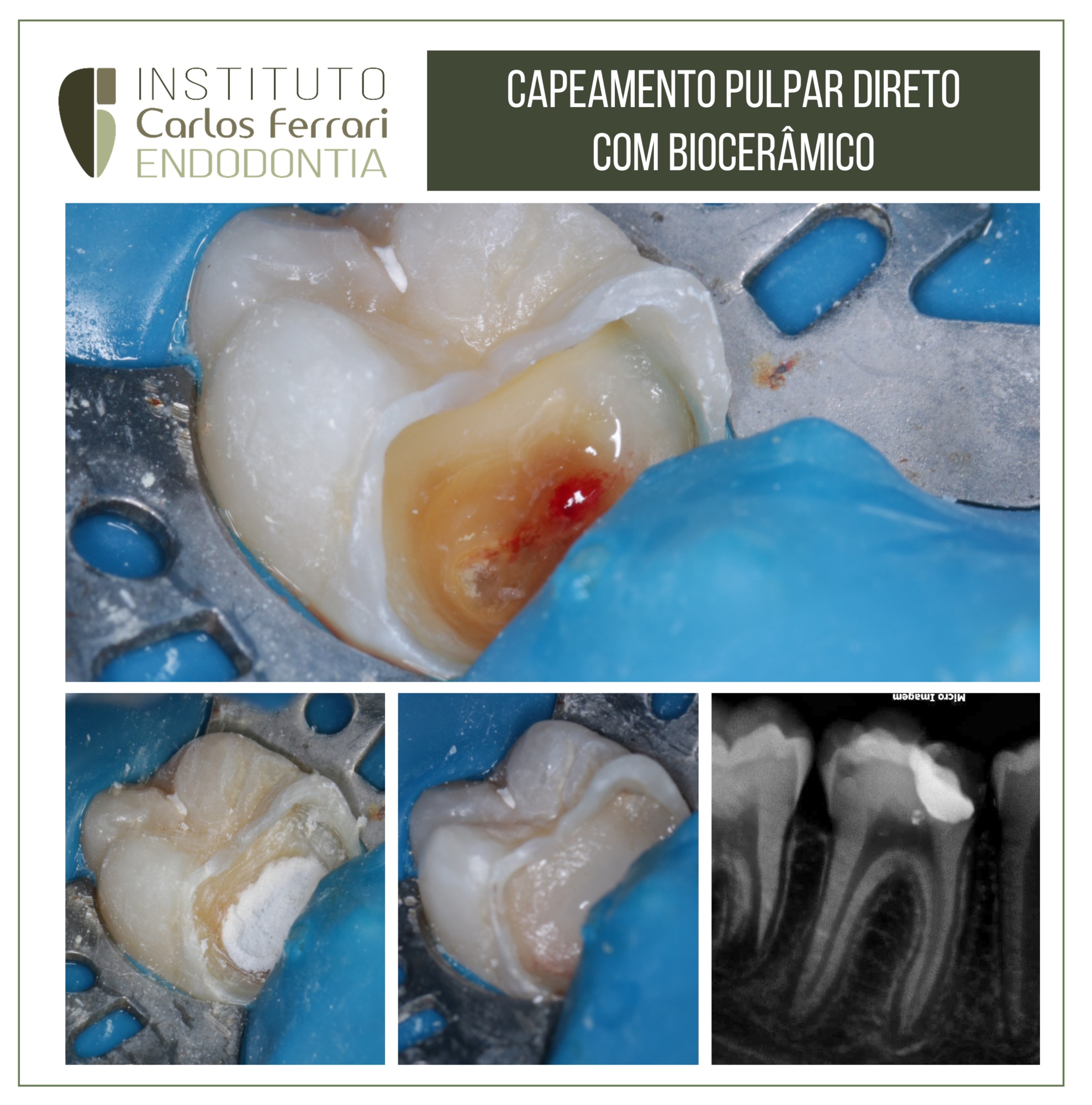 Capeamento pulpar direto com biocerâmico.