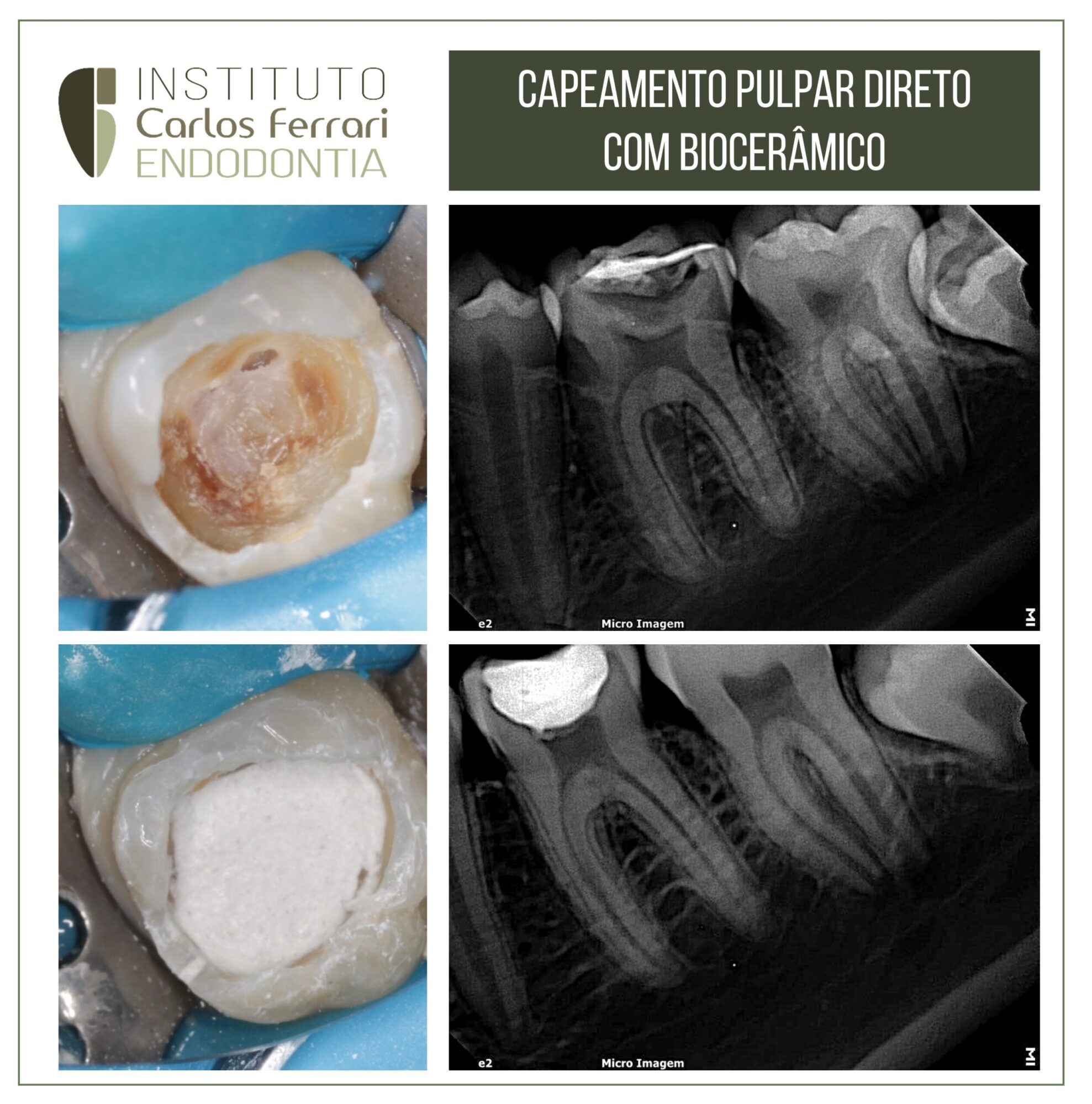 Capeamento pulpar direto com biocerâmico.