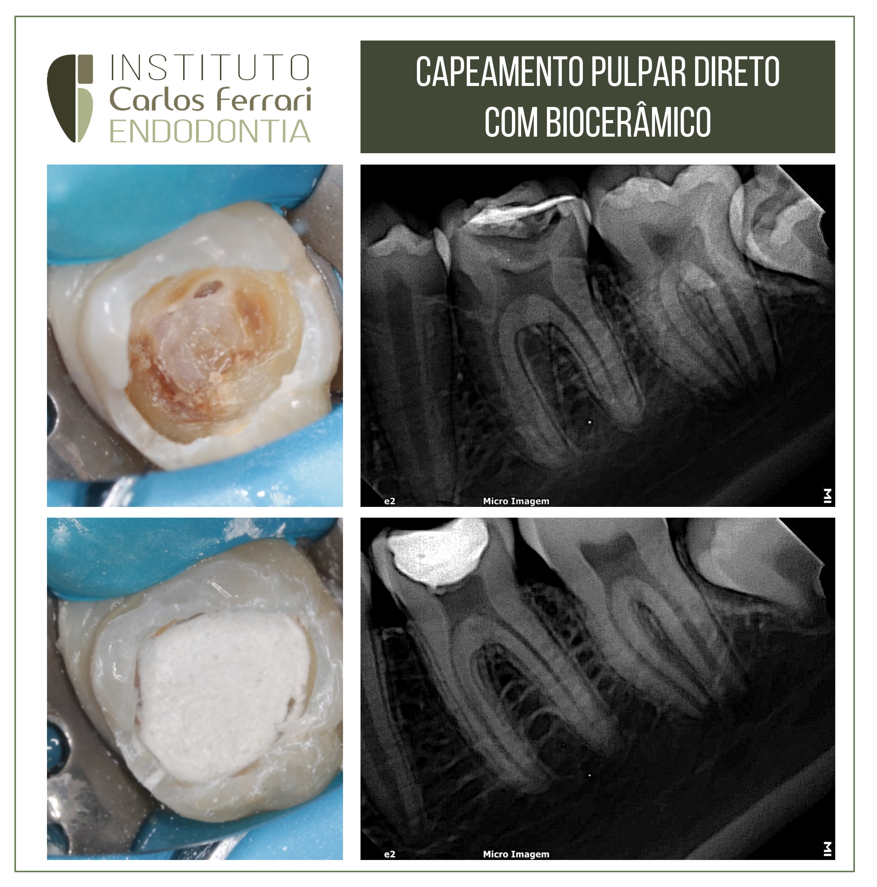 Capeamento pulpar direto com biocerâmico.