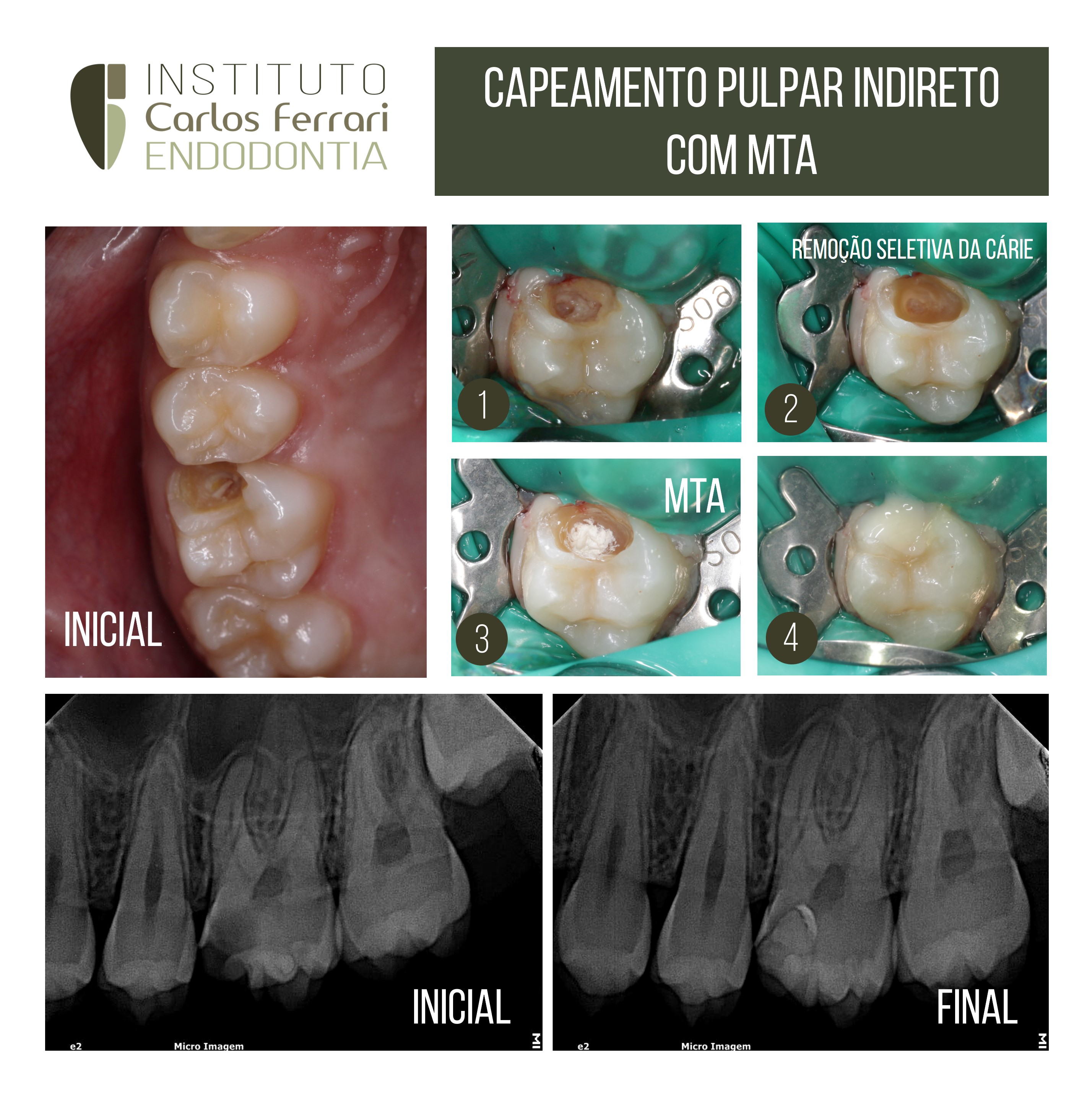 Capeamento pulpar indireto com biocerâmico em rizogênese incompleta.
