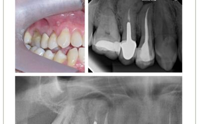 Cementoblastoma benigno. Relato de caso.