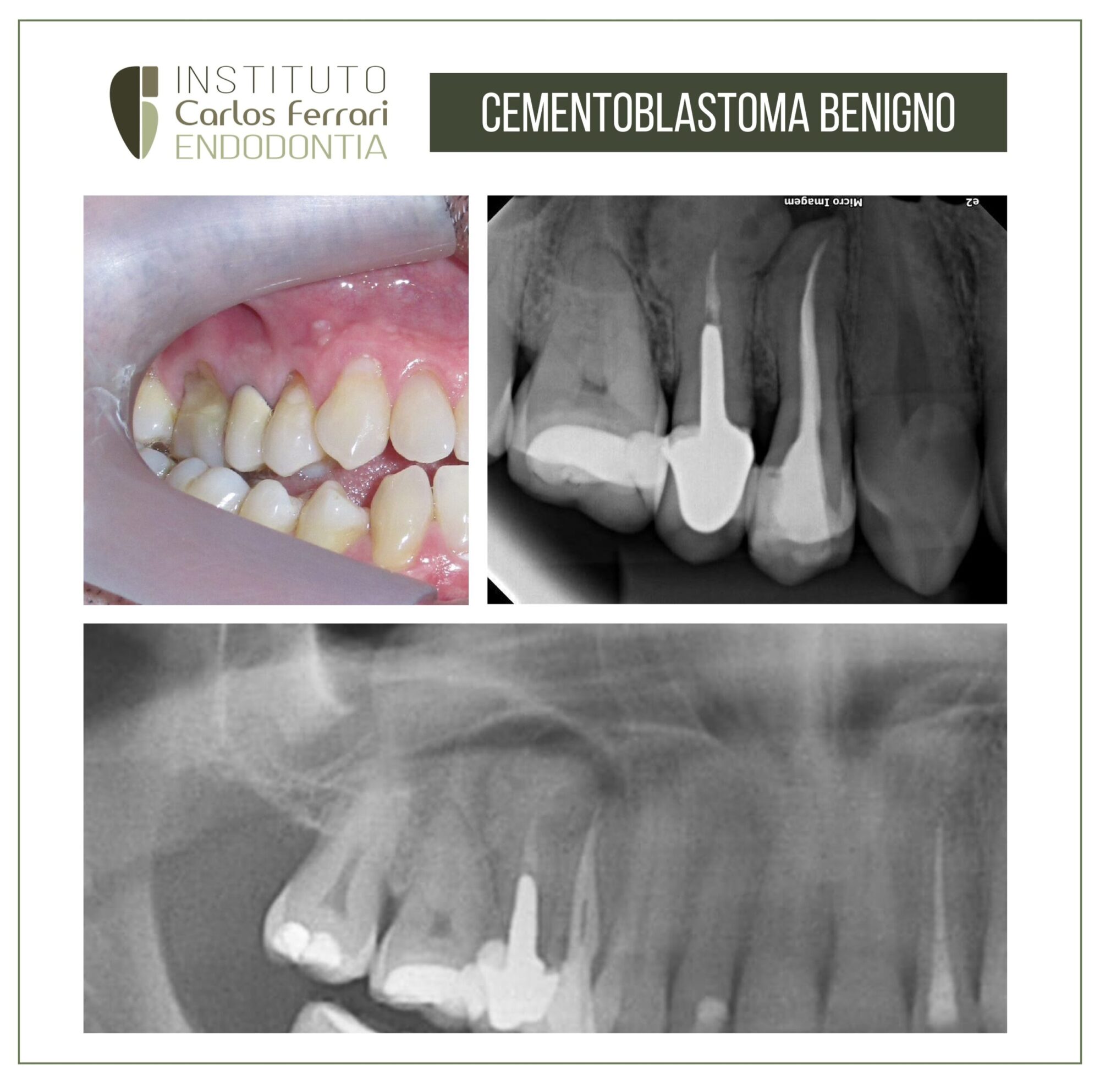 Cementoblastoma benigno. Relato de caso.