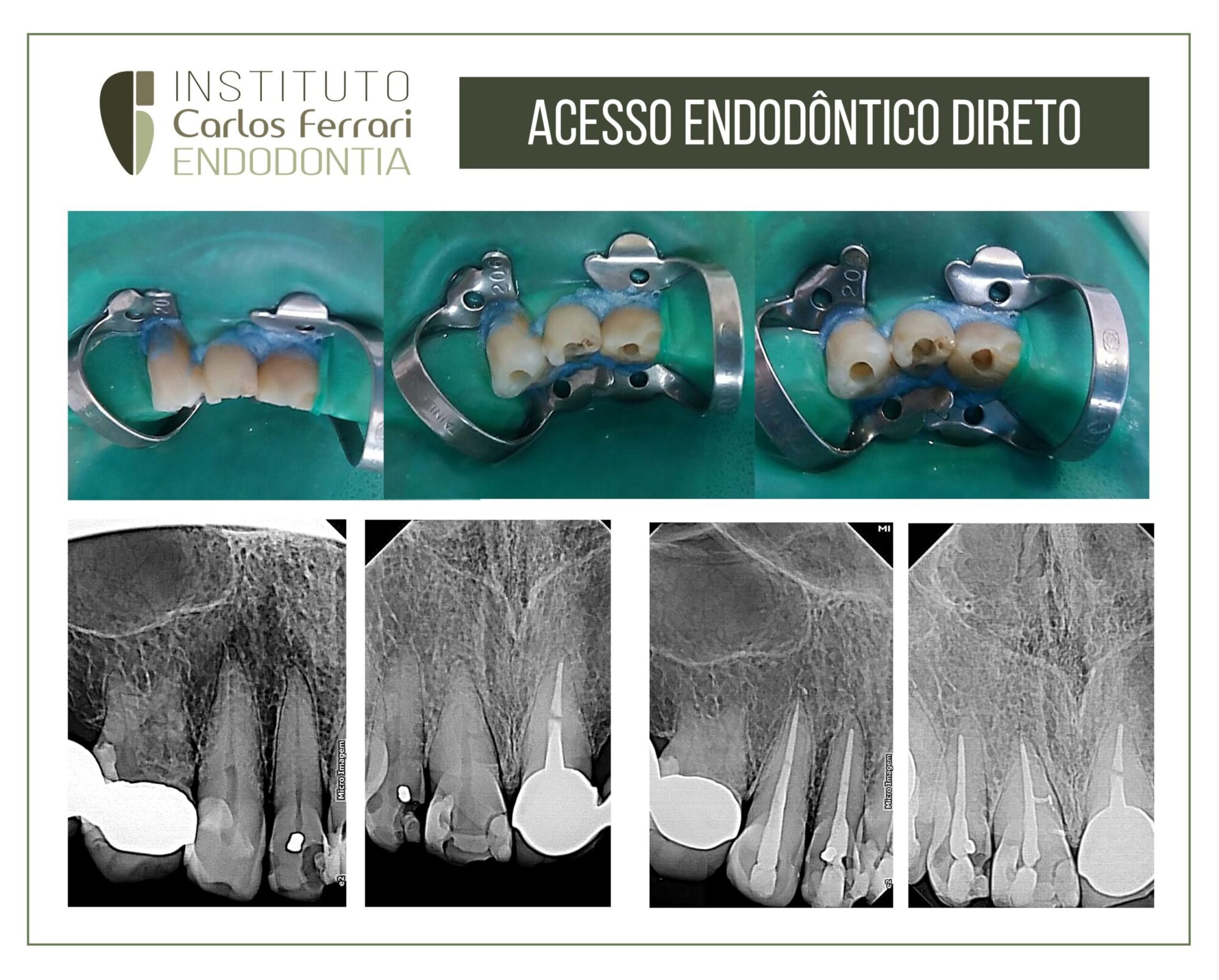 Cirurgia de acesso endodôntica direta.