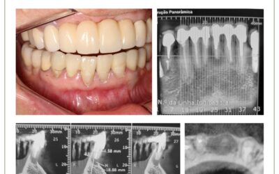 Cirurgia paraendodôntica e prótese fixa.