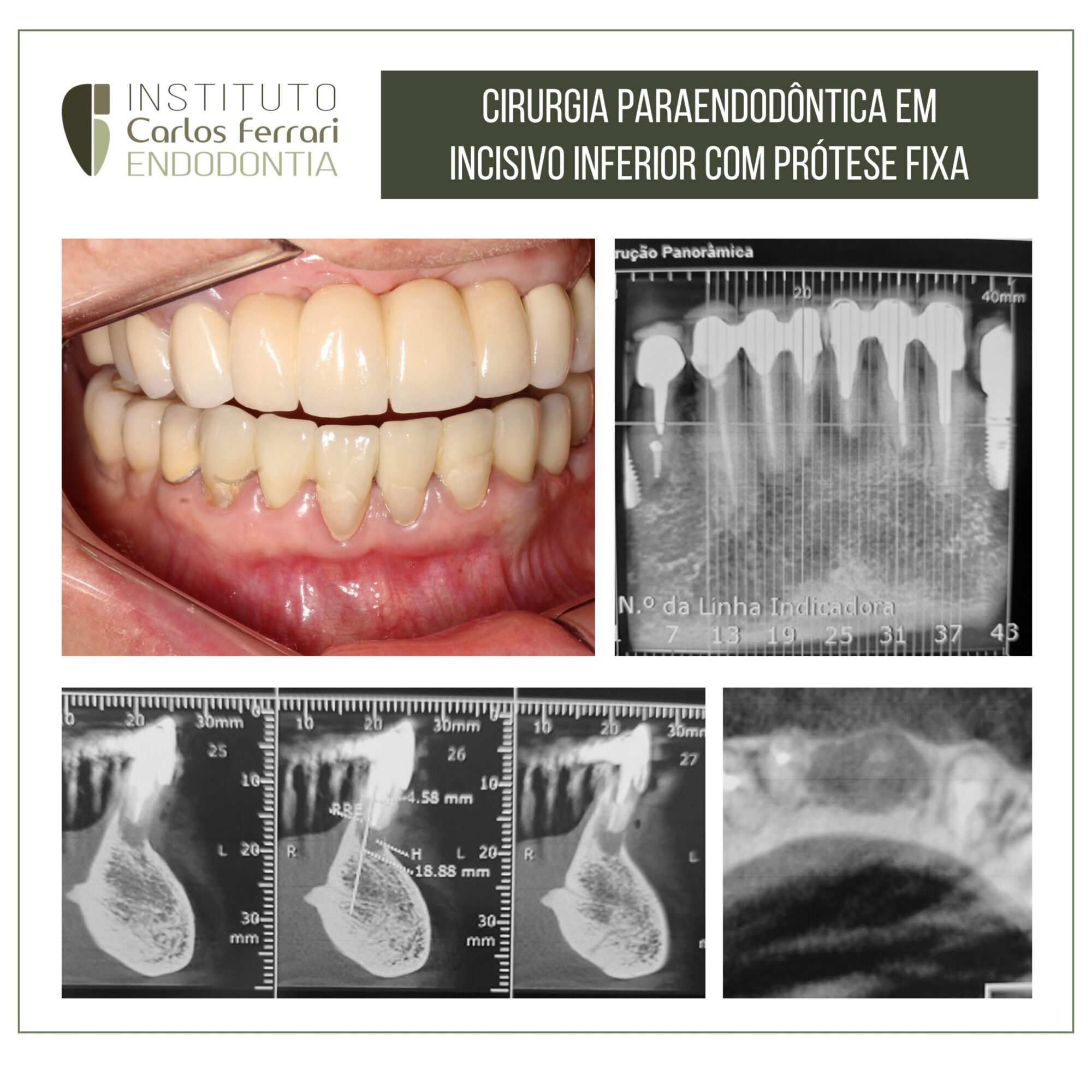 Cirurgia paraendodôntica e prótese fixa.