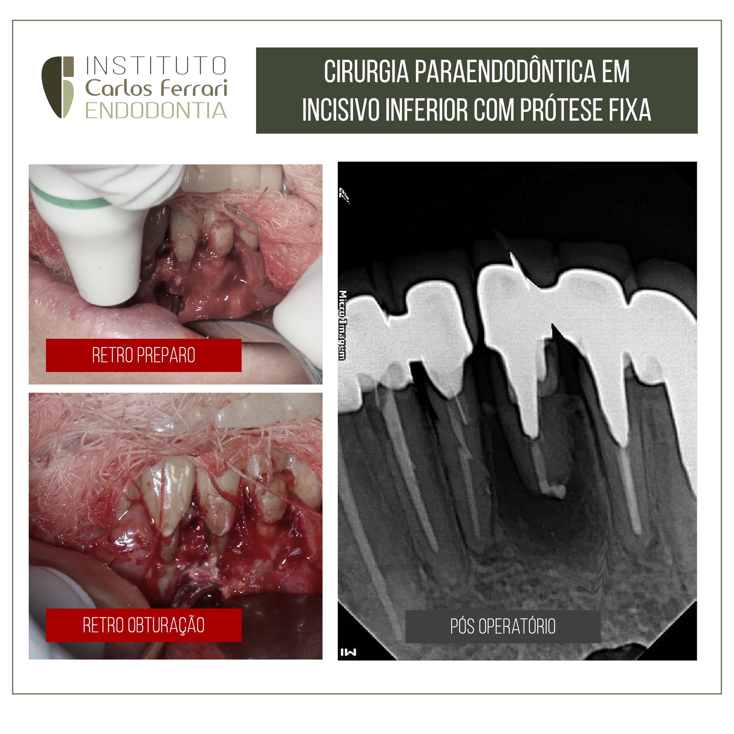 Cirurgia paraendodôntica e prótese fixa.