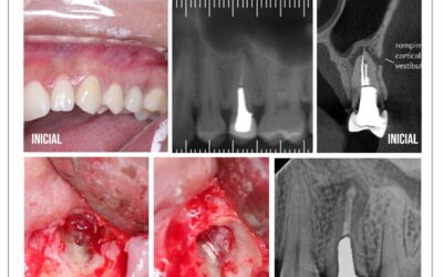 Cirurgia paraendodôntica em pré molar com retentor metálico.