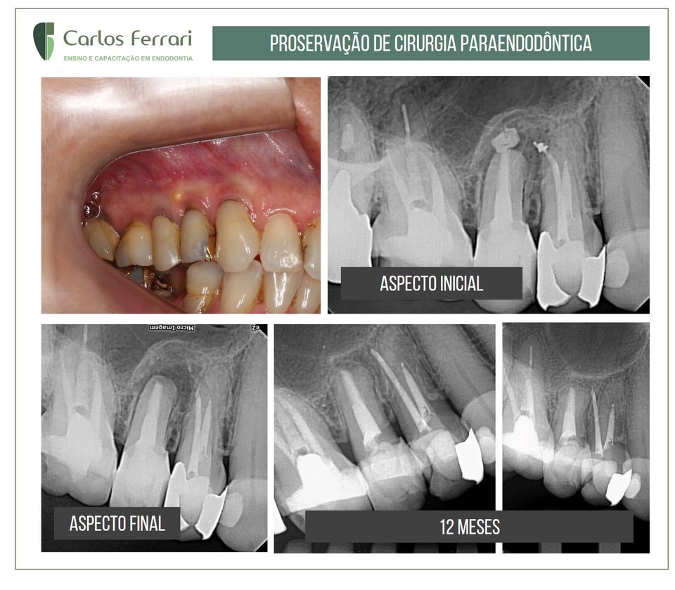 Cirurgia paraendodôntica de pré-molar. Proservação de 12 meses.