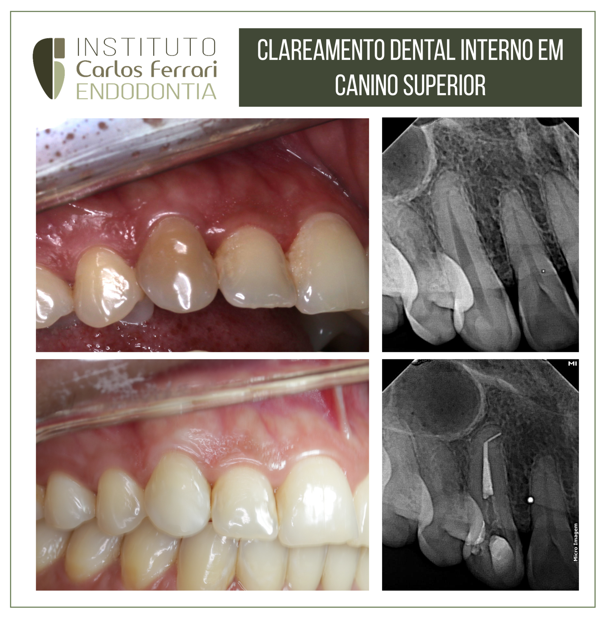 Clareamento dental interno.