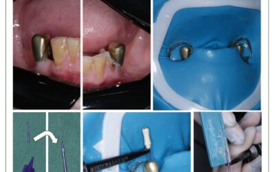 Endodontia em coroa protética. Adaptação para odontometria.