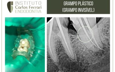 Grampo endodôntico plástico (grampo invisível)