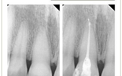 Canal calcificado e ulltrassom. Exploração e tratamento com pontas ultrassônicas.