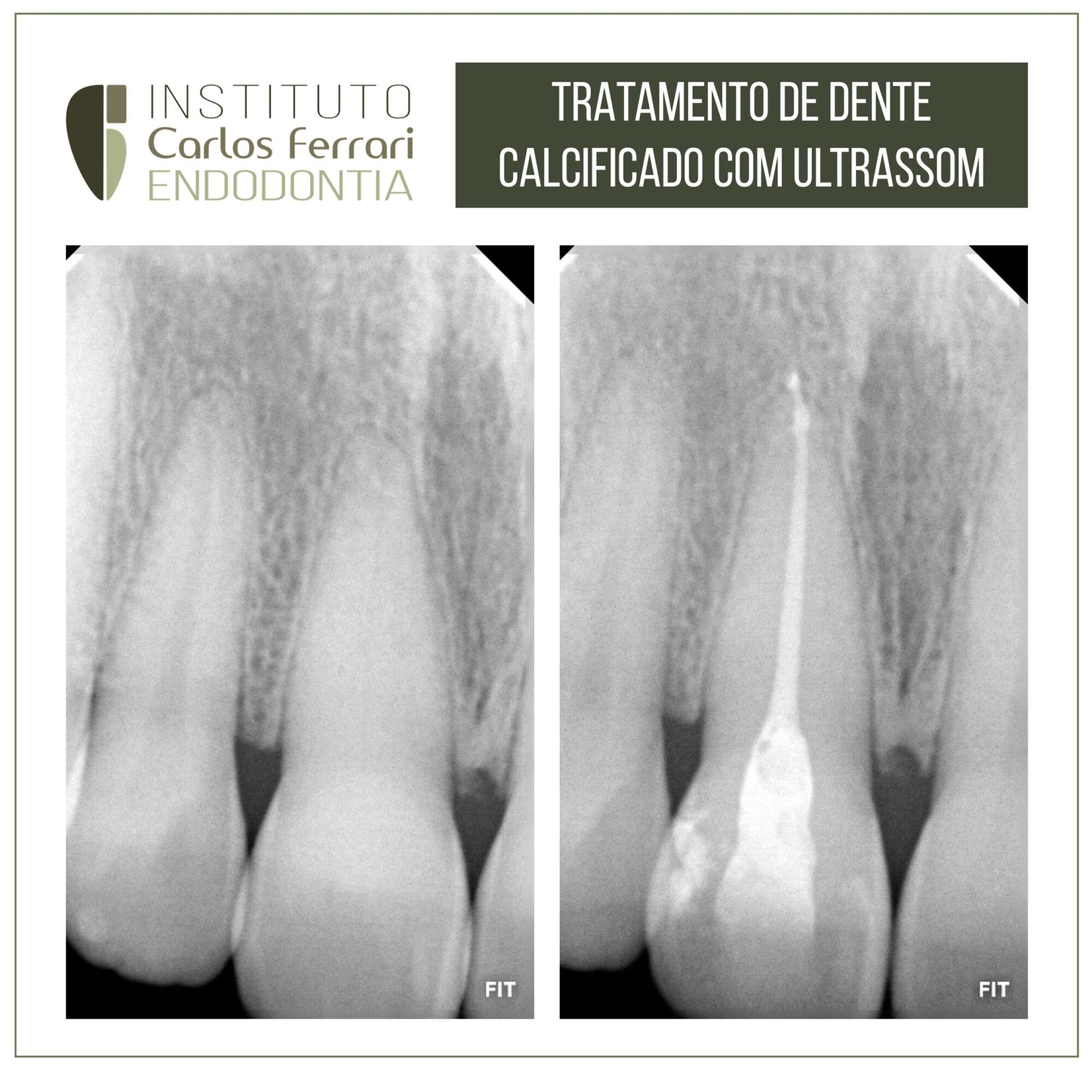 Canal calcificado e ulltrassom. Exploração e tratamento com pontas ultrassônicas.