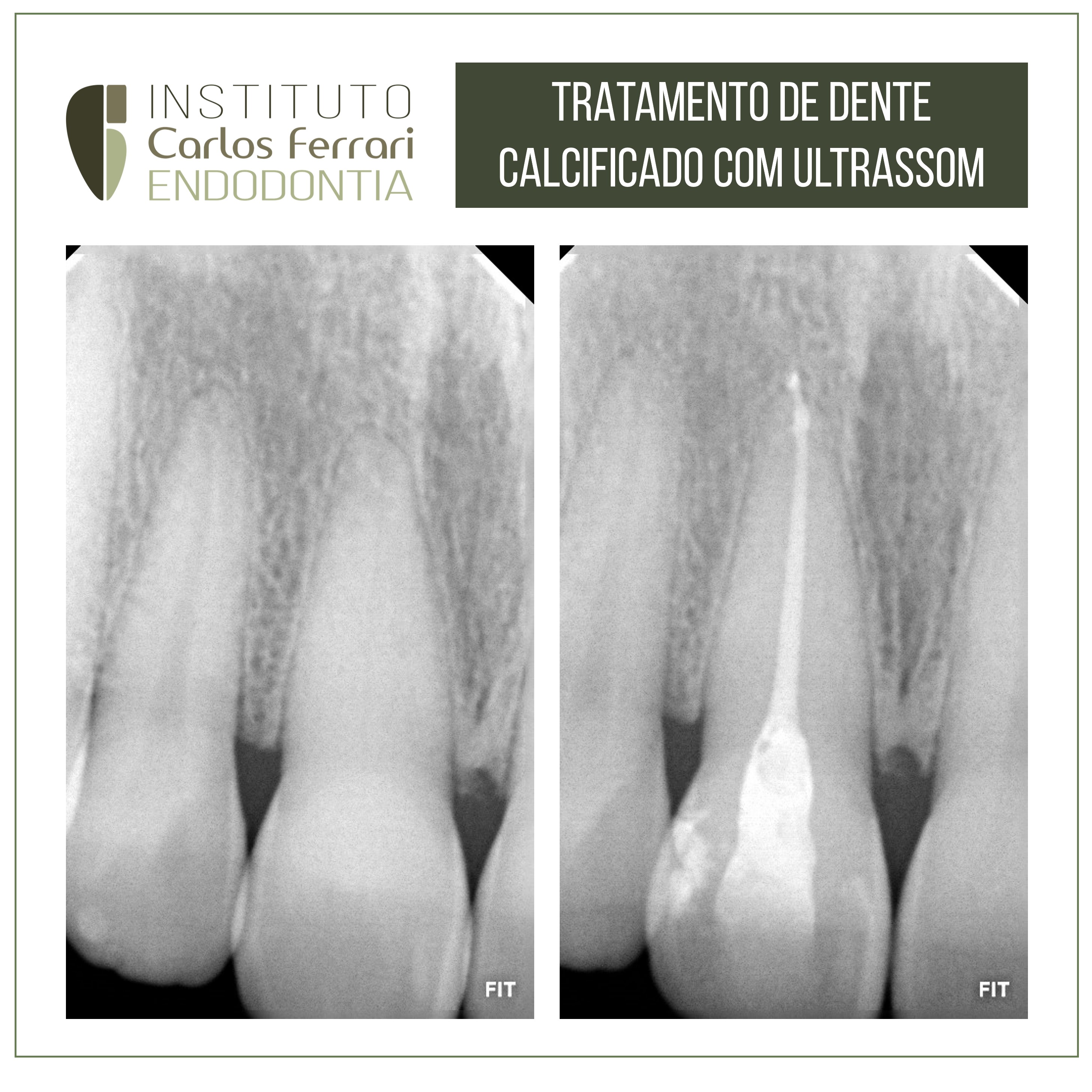 Canal calcificado e ulltrassom. Exploração e tratamento com pontas ultrassônicas.