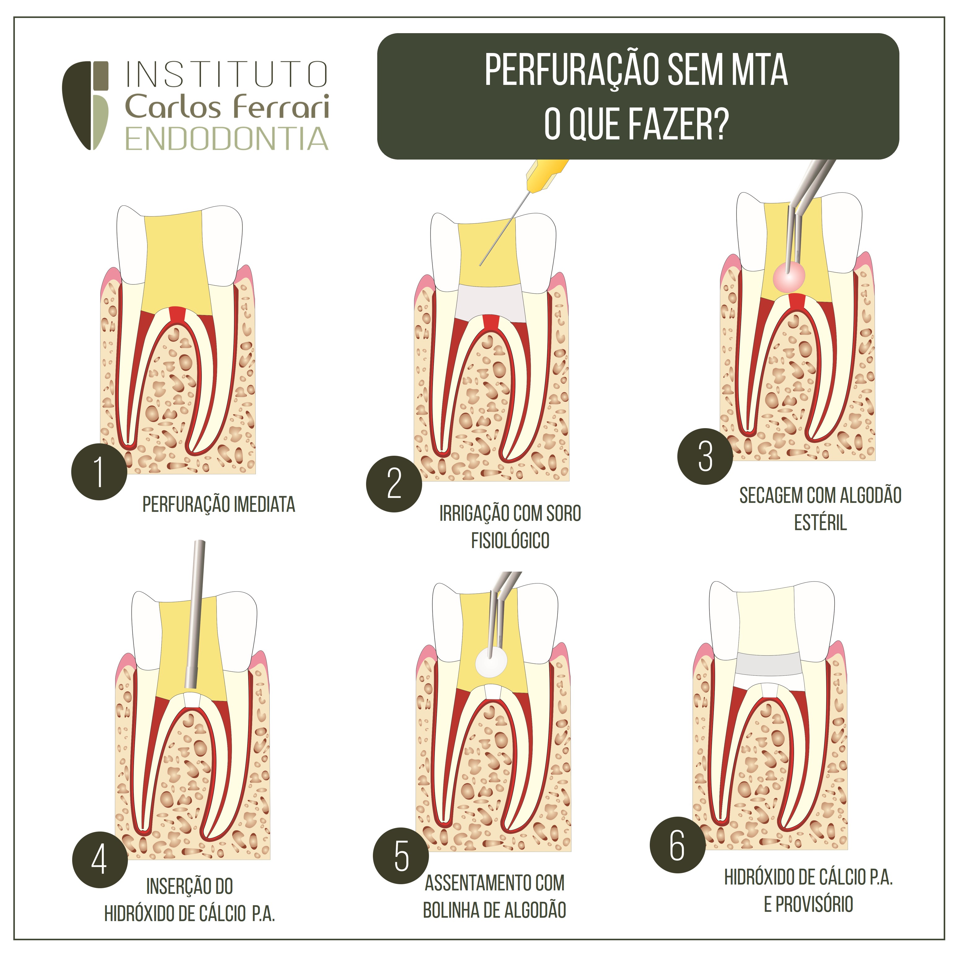 Perfuração sem MTA. O que fazer?