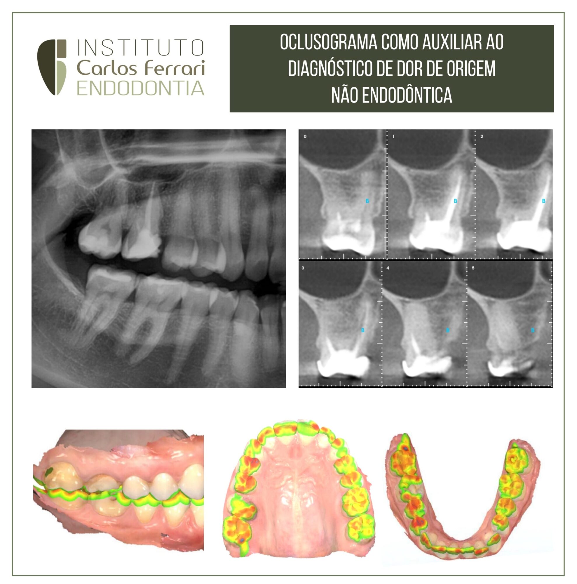 Oclusograma no diagnóstico de dor orofacial.