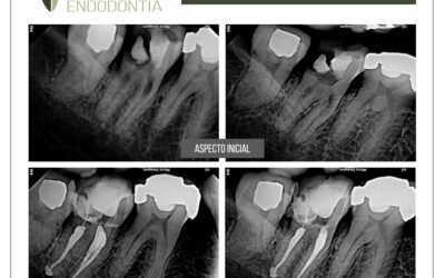 Reabsorção radicular interna em molar inferior.