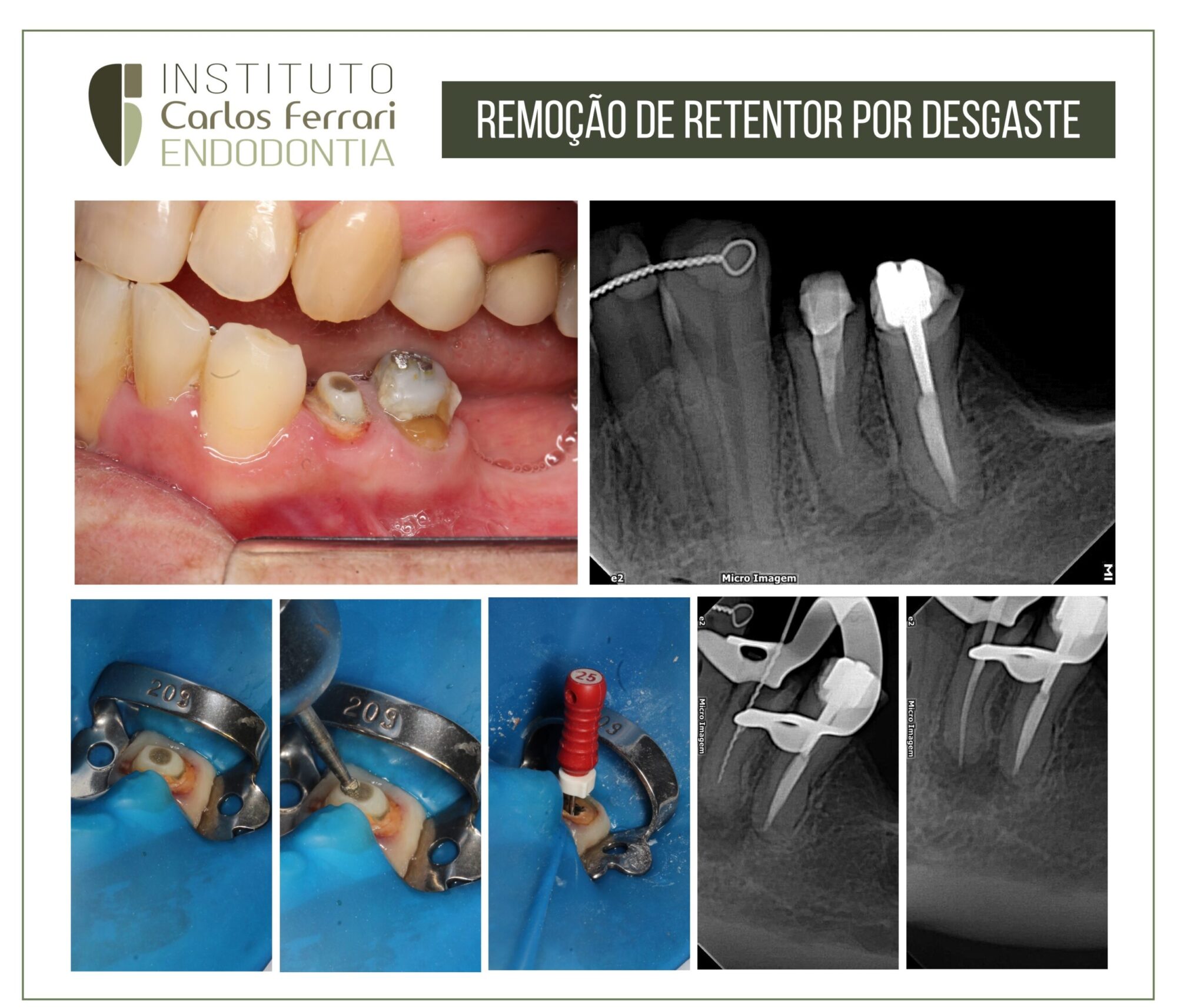 Retentor intrarradicular. Remoção por desgaste.