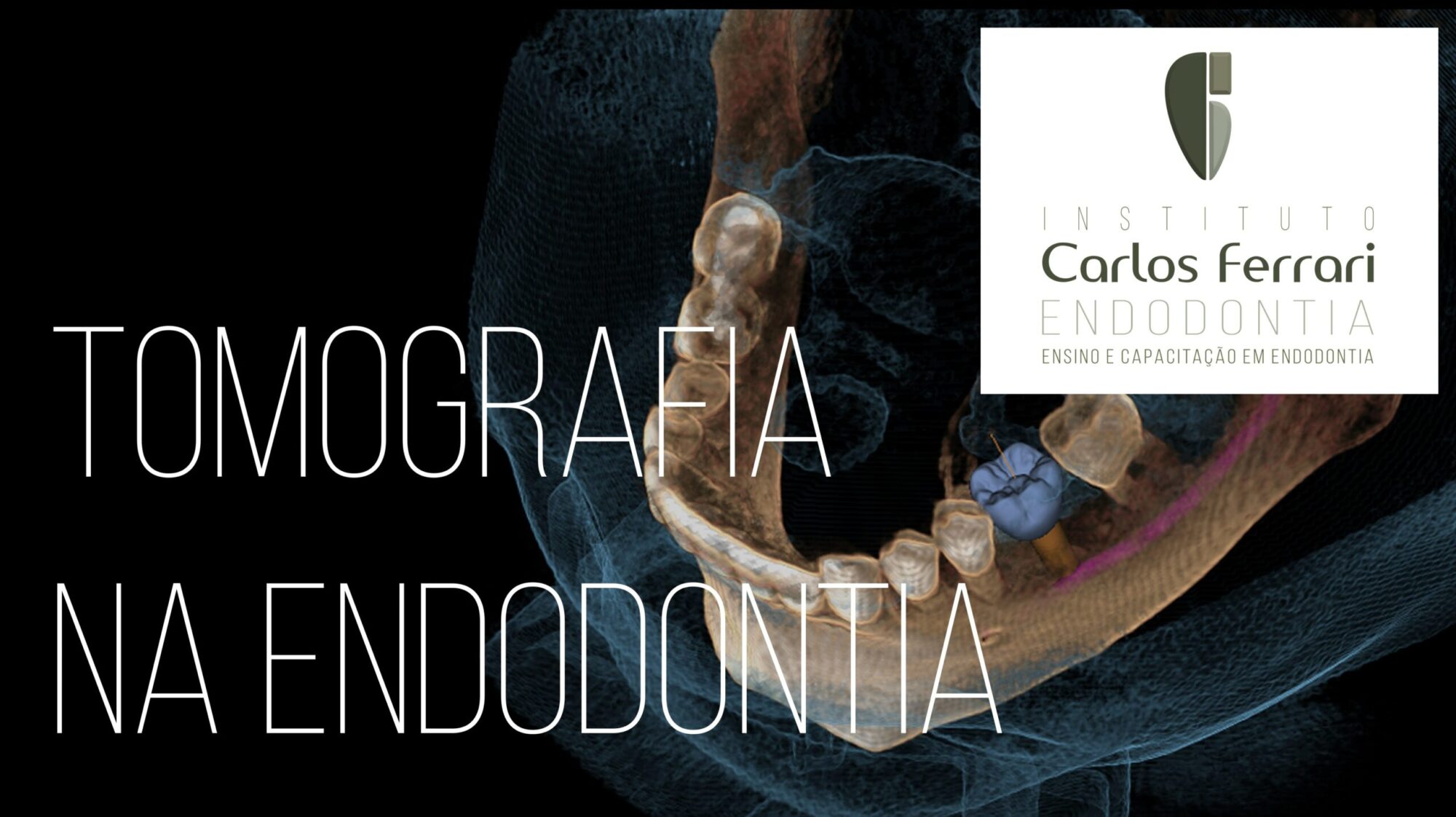 Tomografia na endodontia. Introdução. Aula online.