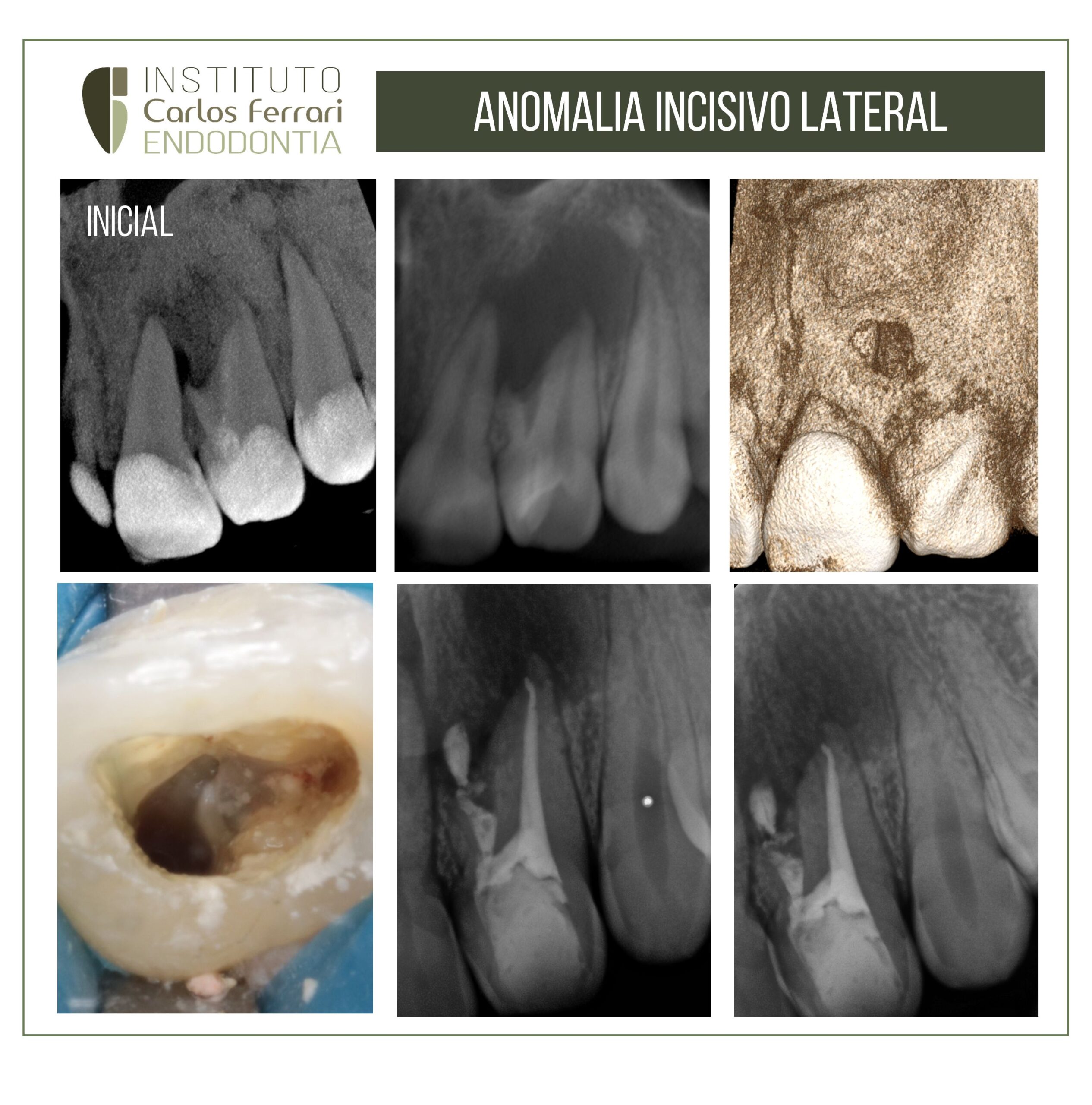 Anomalia em incisivo lateral dens invaginatus