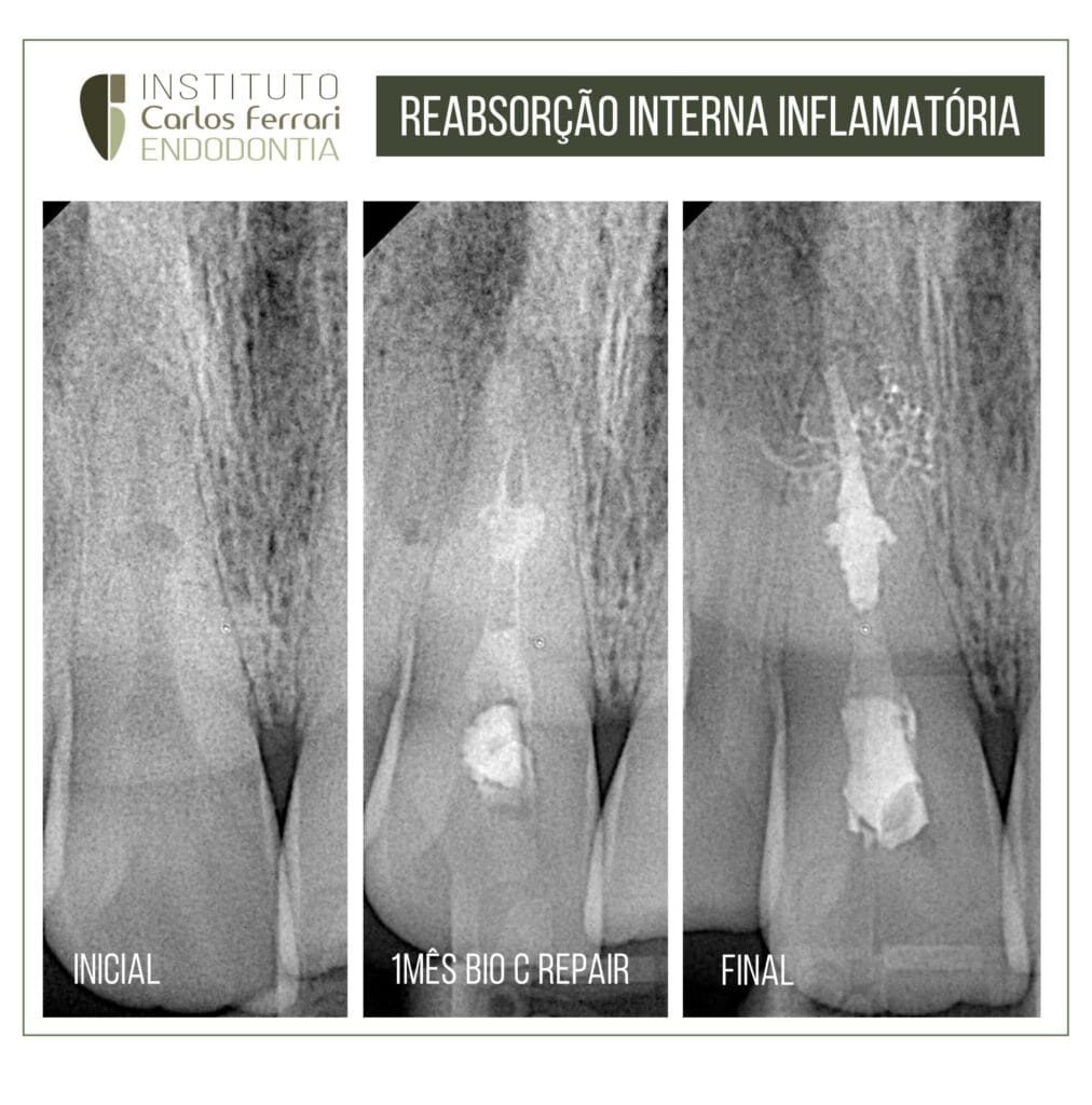 Reabsorção interna