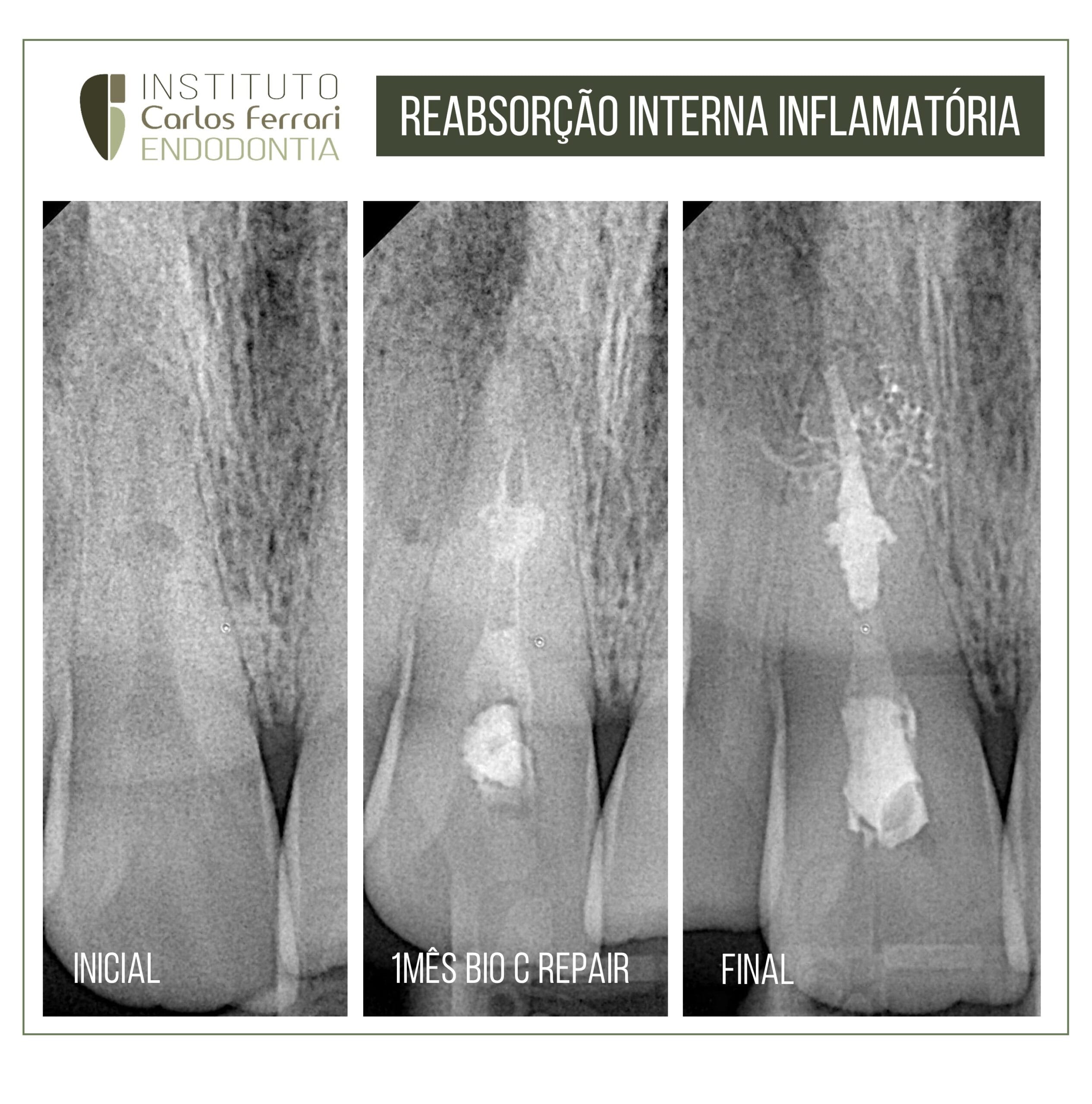 Reabsorção interna