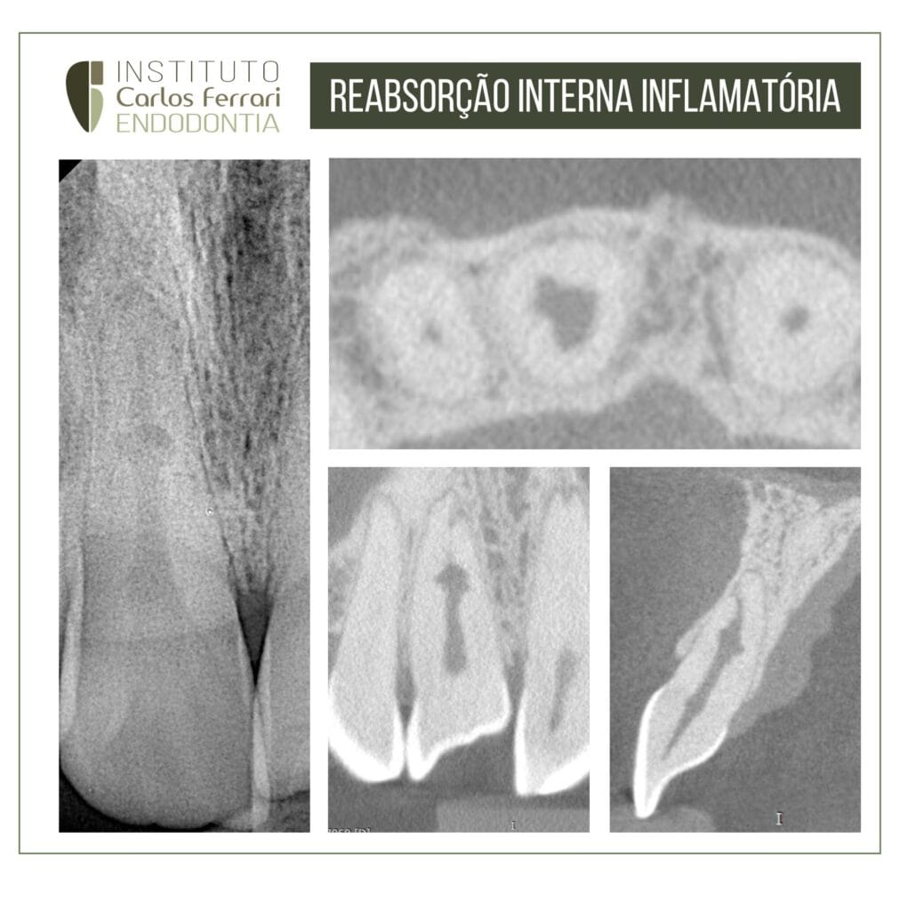 Reabsorção interna