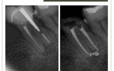 Retratamento em dente com coroa protética e pino rosqueado