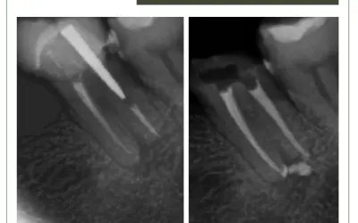 Retratamento em dente com coroa protética e pino rosqueado