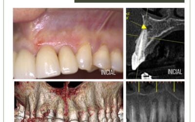 Cirurgia paraendodôntica e terapia fotodinâmica.