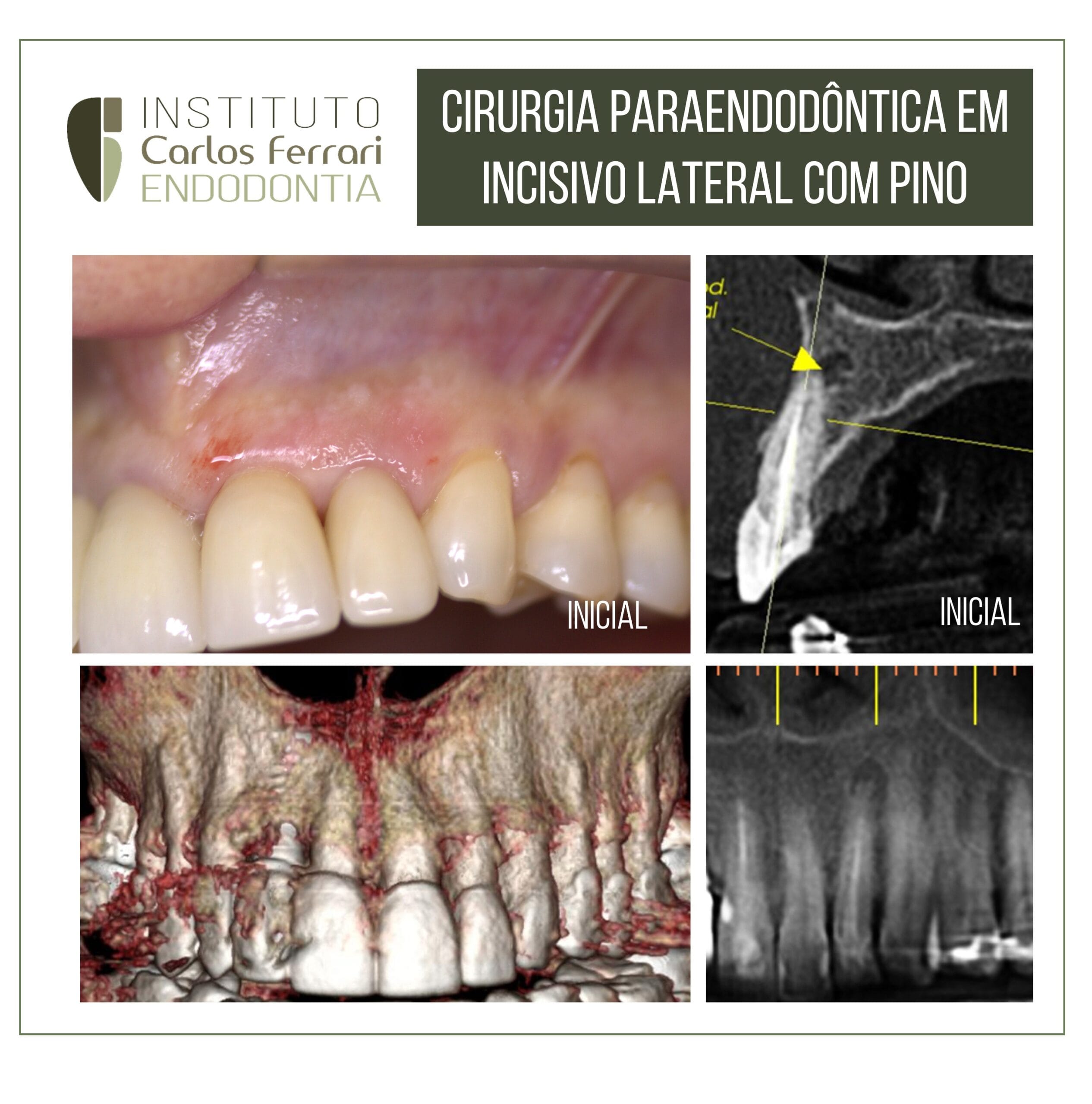 Cirurgia paraendodôntica e terapia fotodinâmica.