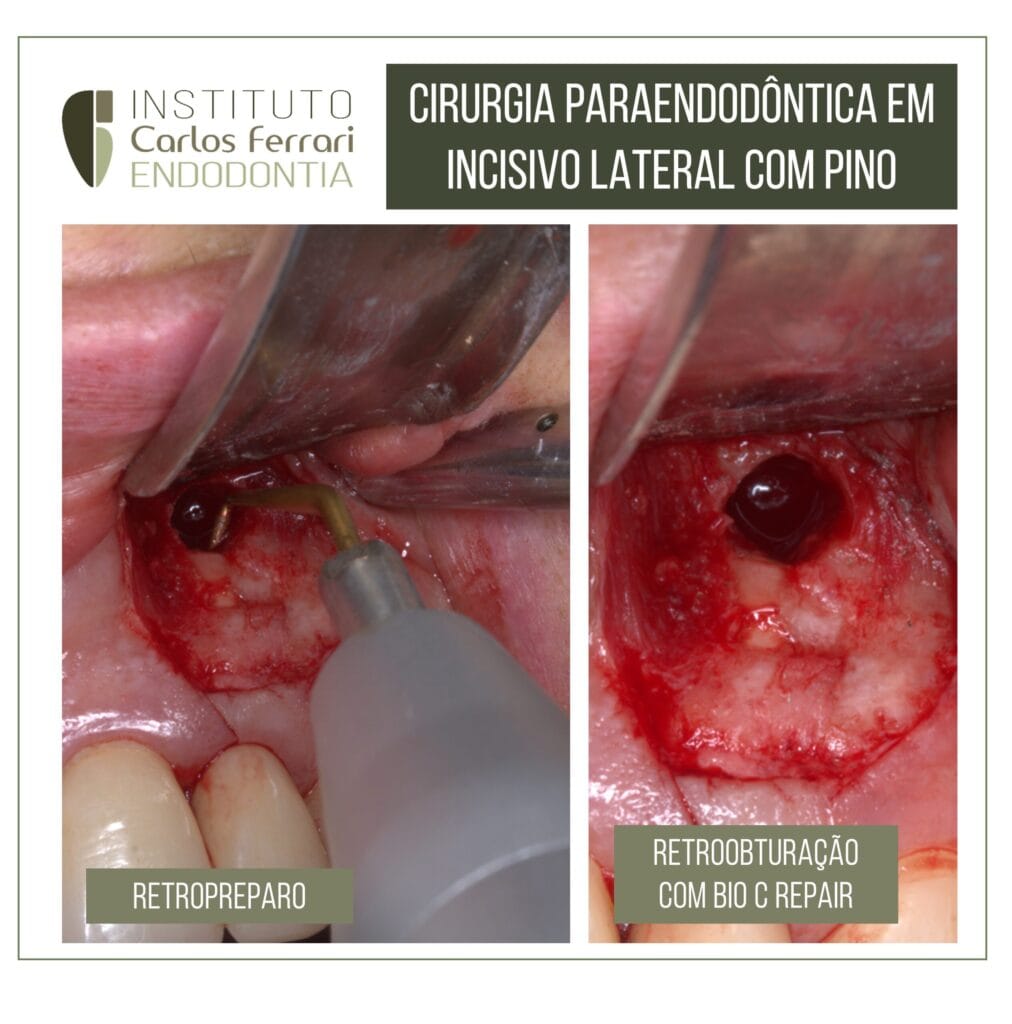 Cirurgia paraendodôntica e terapia fotodinâmica.