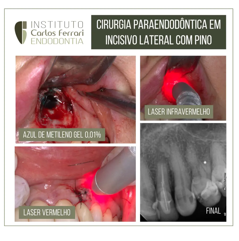 Cirurgia paraendodôntica e terapia fotodinâmica.