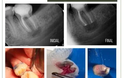 reimplante intencional e terapia fotodinâmica.