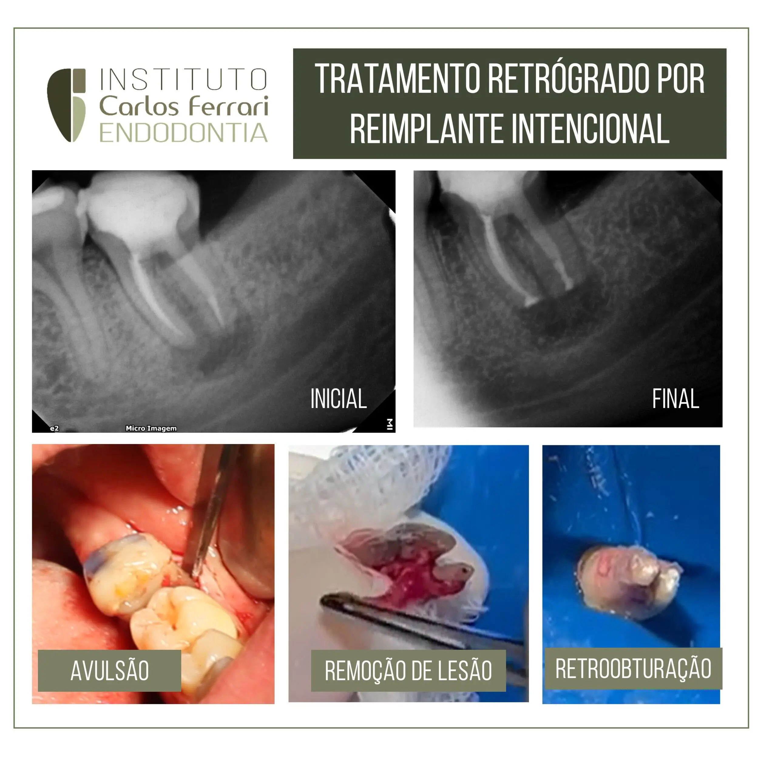 reimplante intencional e terapia fotodinâmica. reimplante intencional e terapia fotodinâmica.