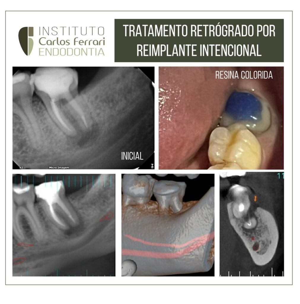 reimplante intencional e terapia fotodinâmica.