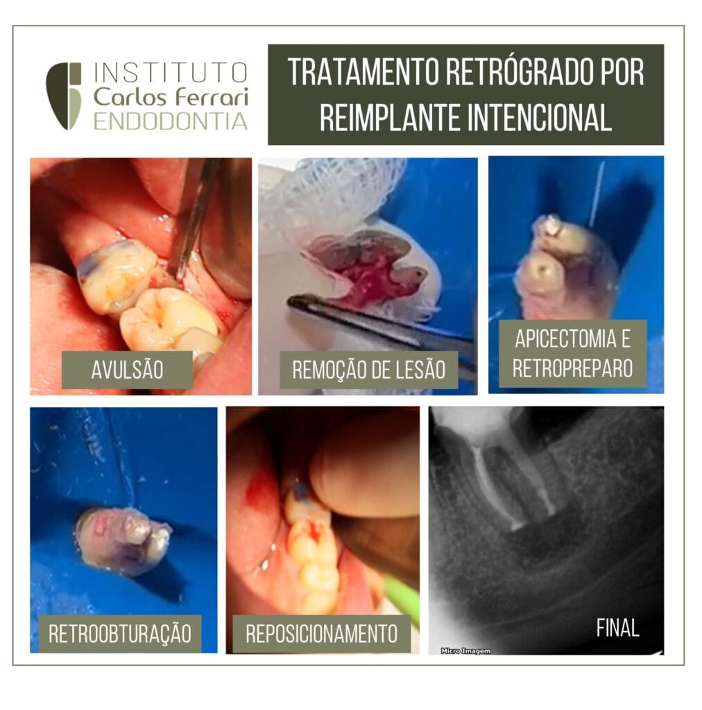 reimplante intencional e terapia fotodinâmica.