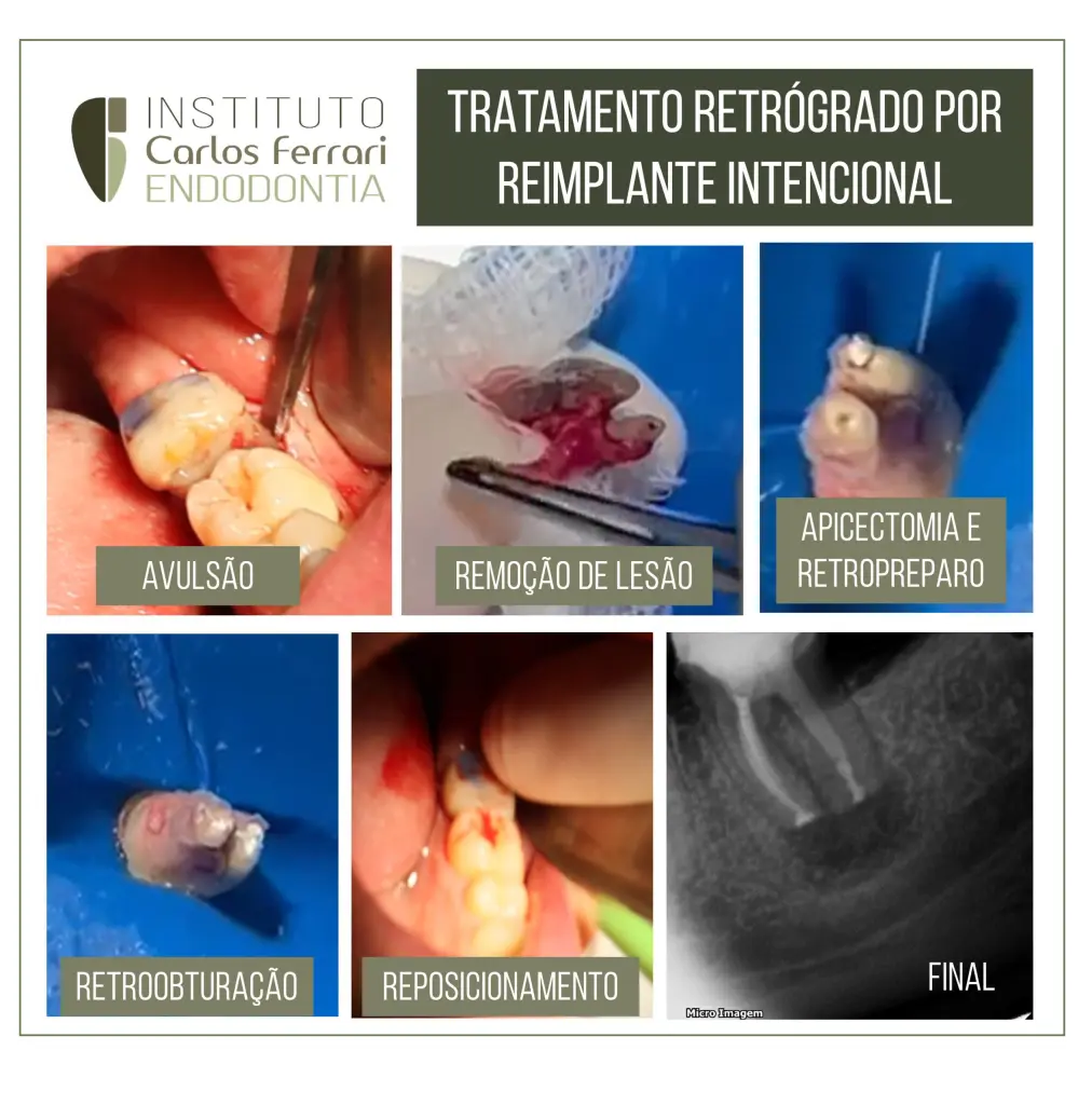 reimplante intencional e terapia fotodinâmica.