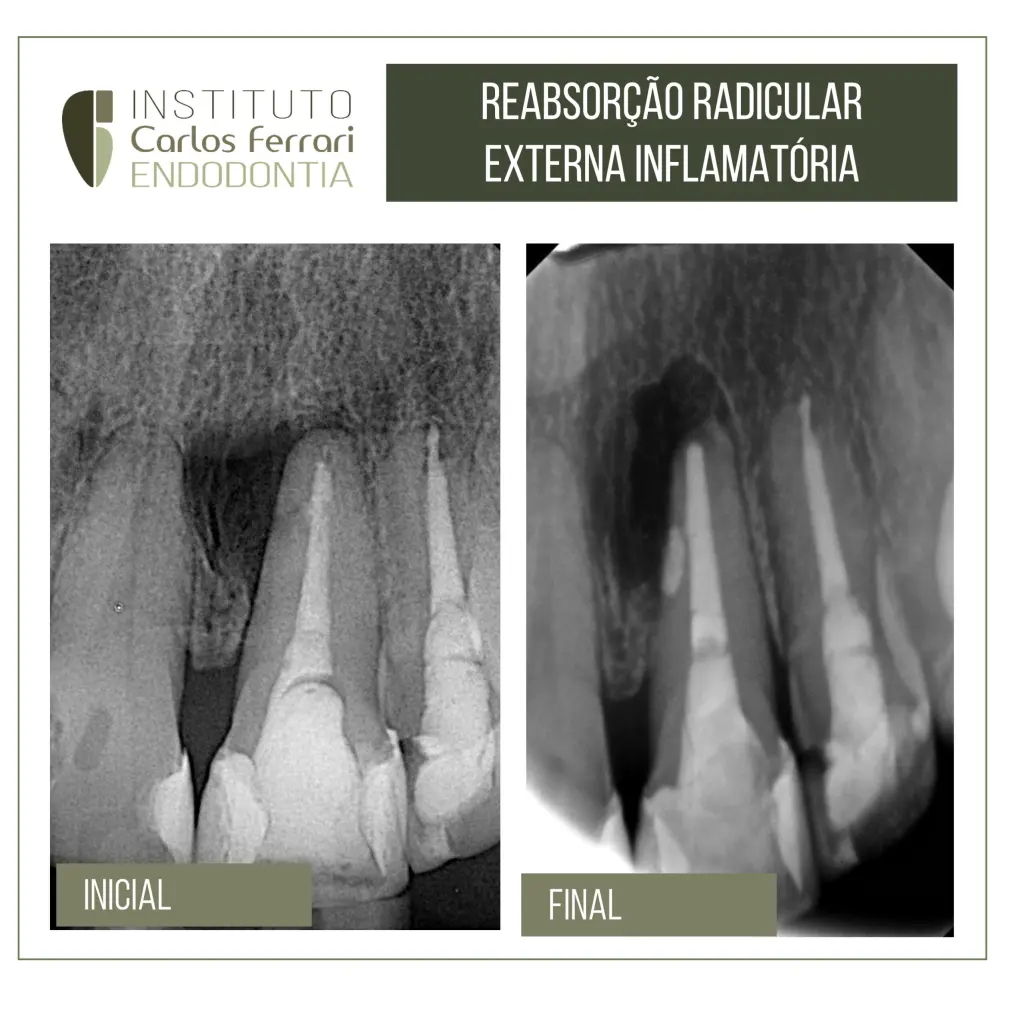 Reabsorção radicular externa e cirurgia paraendodôntica
