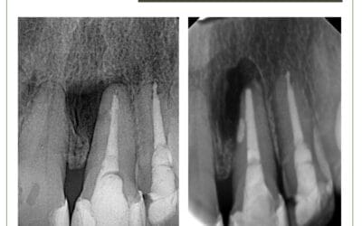 Reabsorção radicular externa e cirurgia paraendodôntica