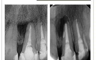 Reabsorção radicular externa e cirurgia paraendodôntica