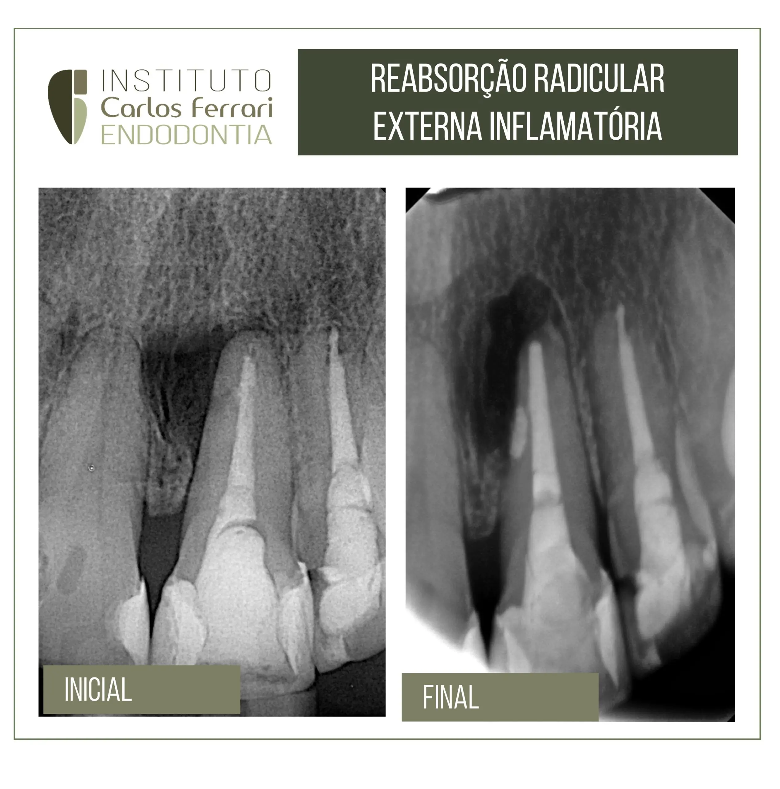 Reabsorção radicular externa e cirurgia paraendodôntica Reabsorção radicular externa e cirurgia paraendodôntica